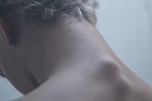 What is Cervical Disc Degeneration